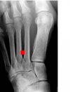 Foot x-ray large w-nail.jpg