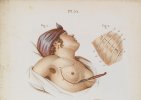 Mastectomy 4.jpg